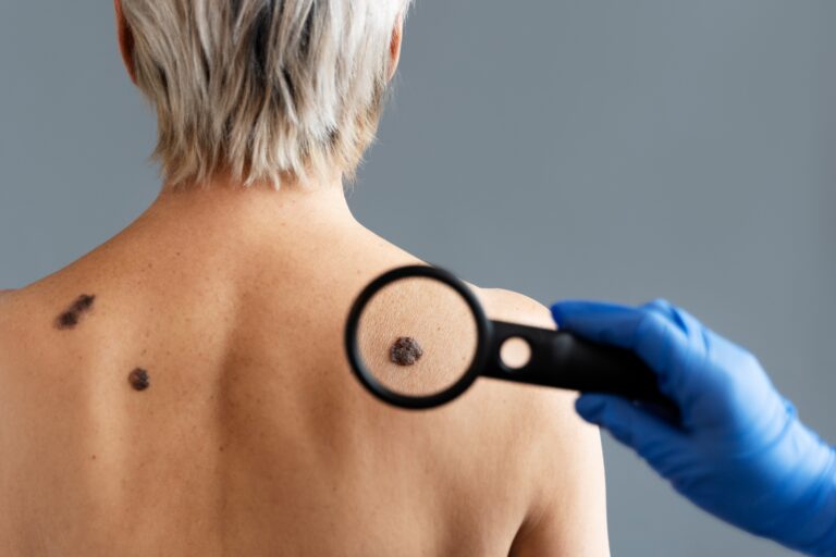 Día Mundial del Cáncer de Piel: refuerzan prevención con consejos sobre autocuidado