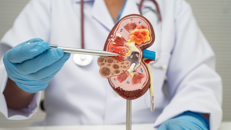 Cáncer de riñón: expertos advierten sobre señales de alerta y factores de riesgo