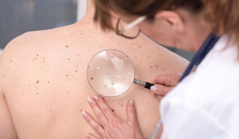 Prevención del cáncer de piel: Un diagnóstico puede salvar vidas