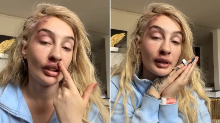 Fran Maira reaparece en redes y muestra su rostro tras sufrir brutal agresión